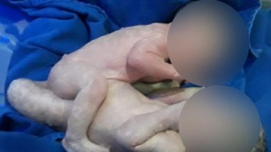 Foto de Siamesas que nasceram em SAJ unidas pela bacia passam por cirurgia de separação em Goiânia