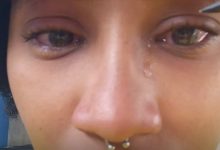 Foto de Mulher tem hemorragia ocular devido a pomada modeladora capilar, em Salvador