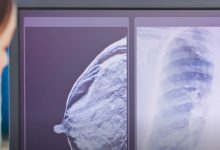 Foto de Pesquisa descobre medicamento que pode evitar metástase após câncer de mama