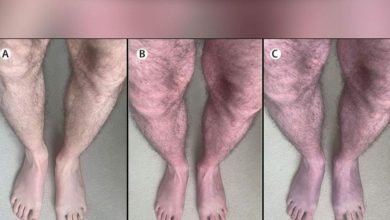Foto de Novo sintoma da COVID-19 é detectado por cientistas: pernas e pés ficam roxos